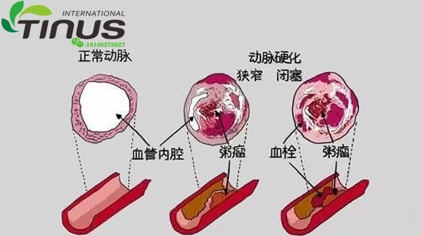 知道为什么NMN被称为“血管清道夫”吗？
